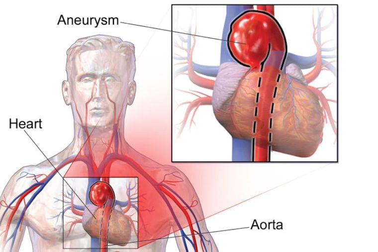 Aortic aneurysms