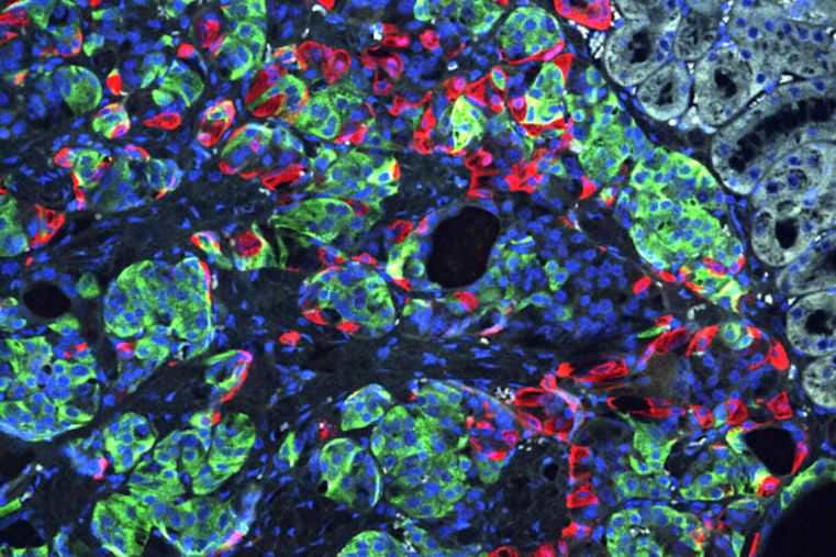 Diabetes reversed in mice with genetically edited stem cells derived from patients